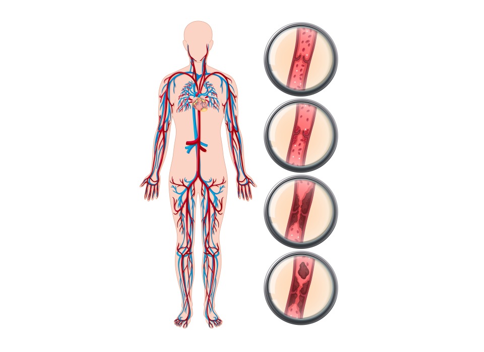 Best varcos venis treatment in coimbatore