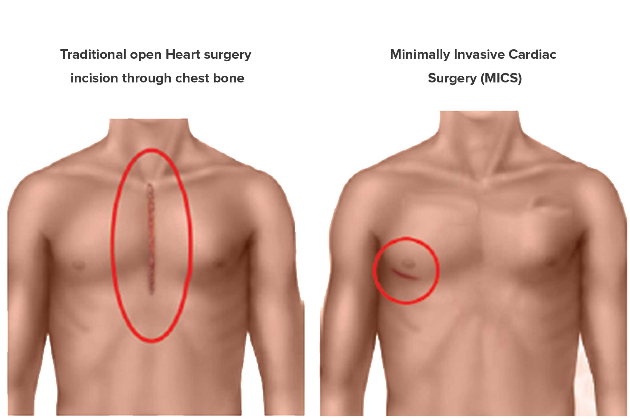 Minimally Invasive Cardiac Surgery